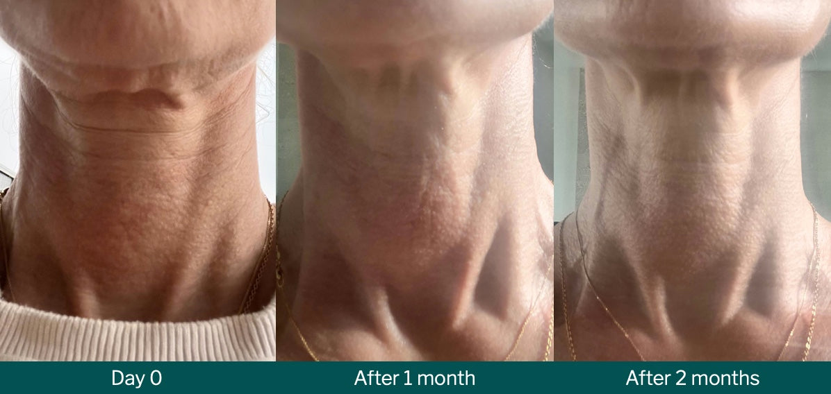 ReSculpt Cosmedical Neck & Body Treatment